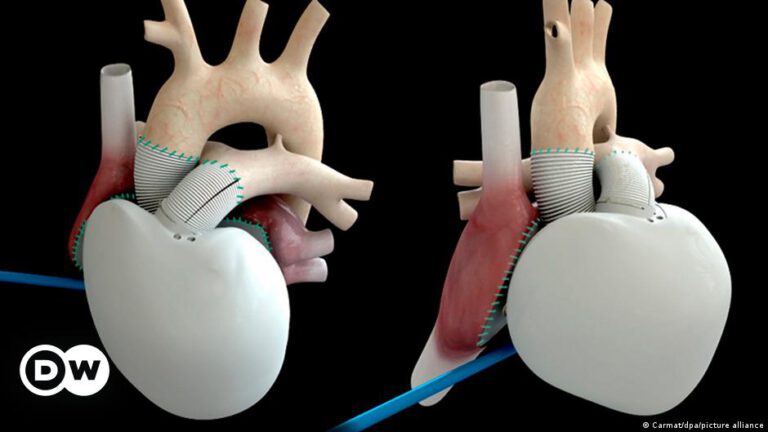Der Traum vom Kunstherz – DW – 18.12.2023